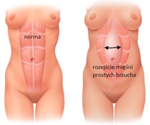 Rozejście mięśni prostych brzucha