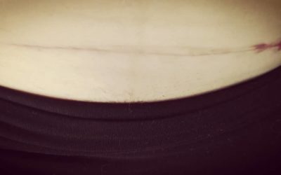 TERAPIA BLIZN jak dbać o bliznę po cc 400x250 - TERAPIA BLIZN