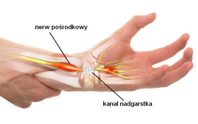 BLOG zespół cieśni nadgarstka 400x250 - BLOG