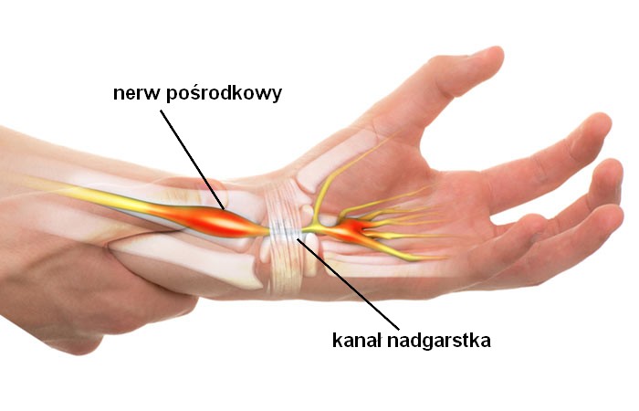 Zespół cieśni nadgarstka