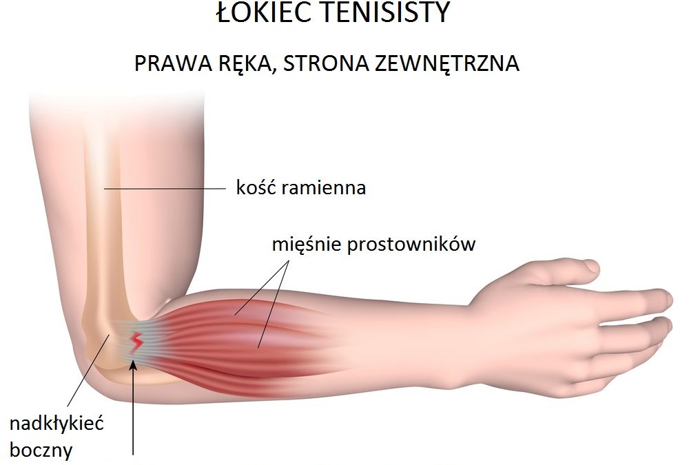 Łokieć tenisisty
