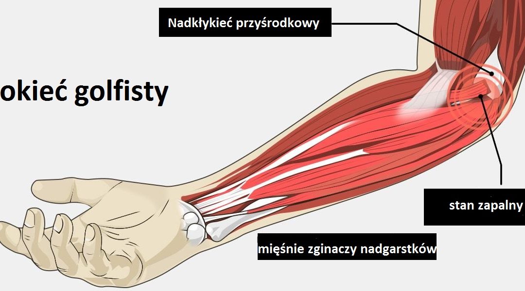 Łokieć golfisty