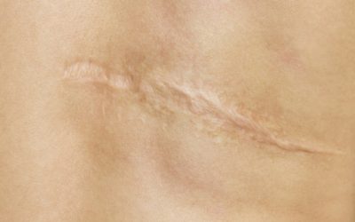 TERAPIA BLIZN blizna 400x250 - TERAPIA BLIZN
