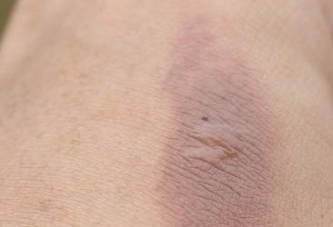 TERAPIA BLIZN blizny po oparzeniu 366x250 - TERAPIA BLIZN