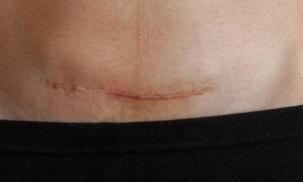 objaw niche -