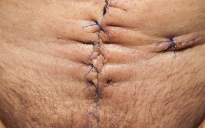 TERAPIA BLIZN terapia blizn 400x250 - TERAPIA BLIZN