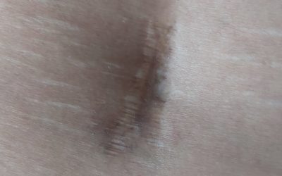 TERAPIA BLIZN blizna stwardniala 400x250 - TERAPIA BLIZN