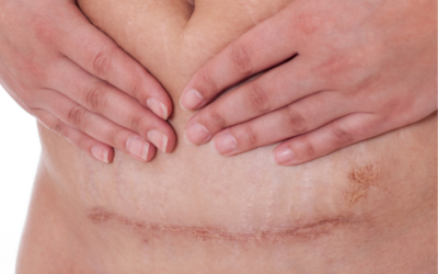 Endometrioza w bliznie 400x250 - Endometrioza w bliznie 400x250 -