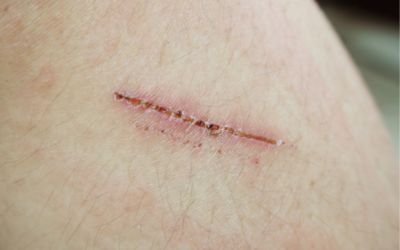 TERAPIA BLIZN zdrapywanie strupa 400x250 - TERAPIA BLIZN