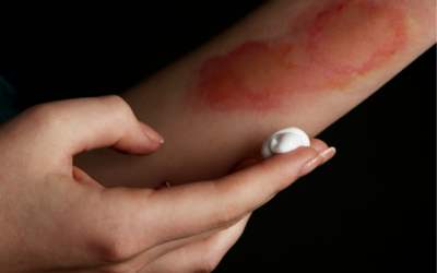 TERAPIA BLIZN masc na blizny 400x250 - TERAPIA BLIZN